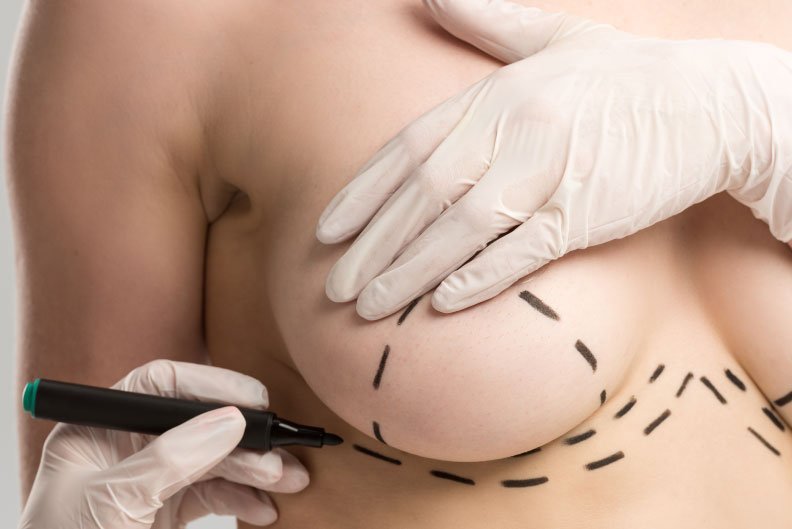 levantamiento-de-senos-cicatriz levantamiento de senos cicatriz